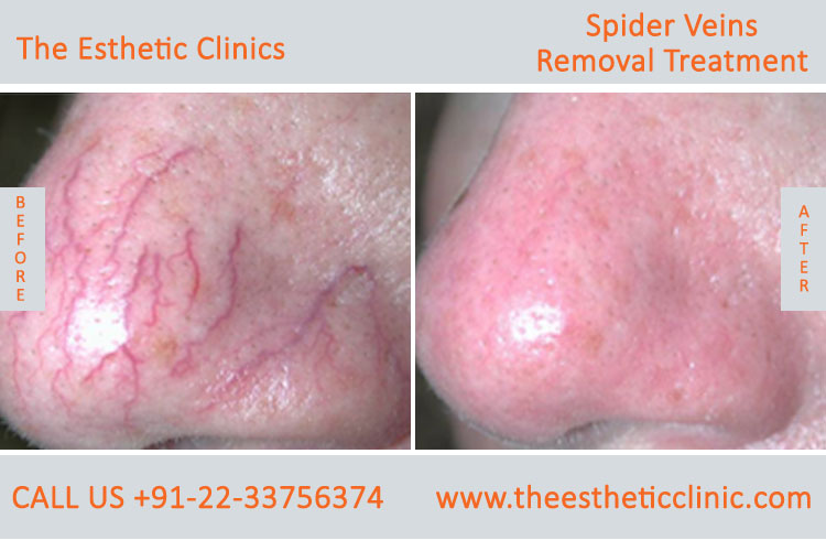 Spider Veins Removal Varicose Veins Laser Treatment before after photos mumbai india (1)